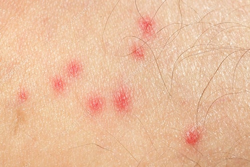 mosquito bites